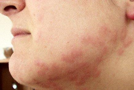 Bed bug bites